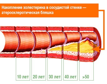 «Хороший» и «плохой» холестерин